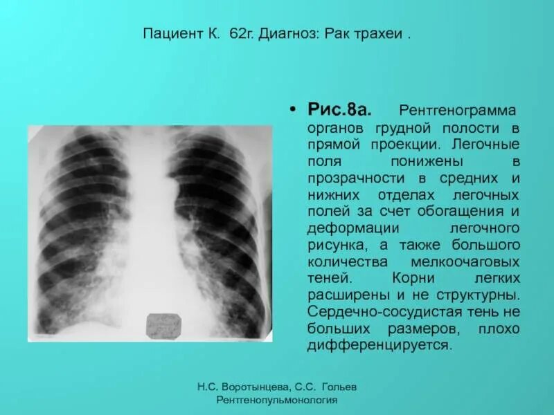 Очаговая форма туберкулеза рентген. Рентген органов грудной клетки в прямой проекции. Изменение контура легкого. Инфильтративный туберкулез левого легкого рентгенограмма. Диагноз периферическое образование верхней доли правого легкого.
