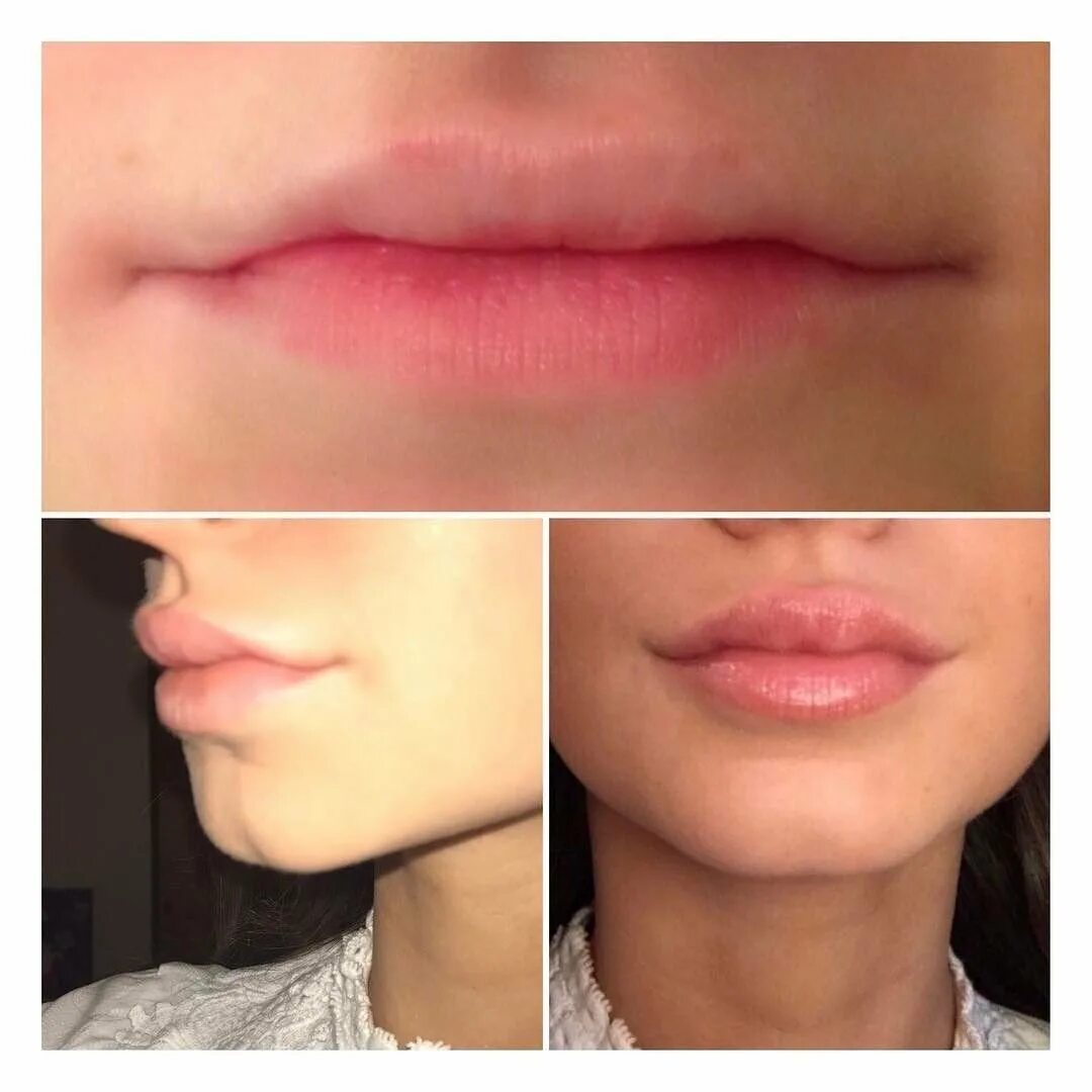 Увеличение губ усы гиалуроновые. Формы губ для увеличения гиалуроновой кислотой.