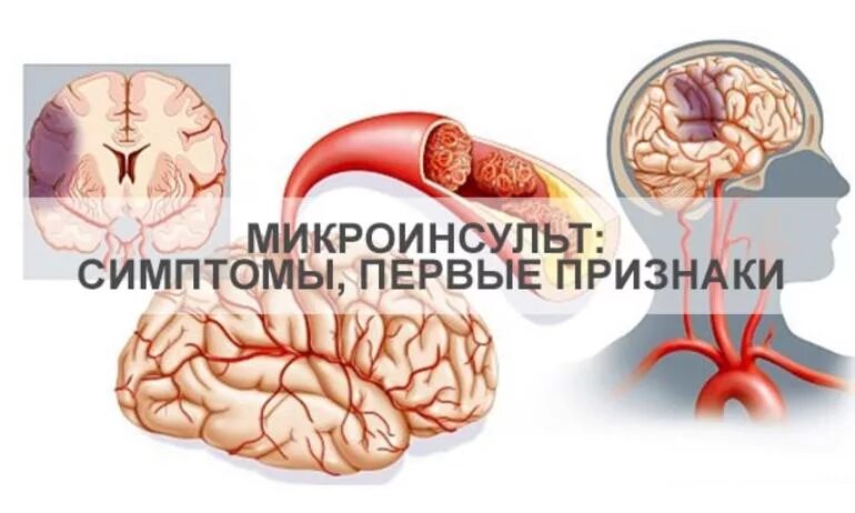 Микроинсульт что делать. Микроинсульт. Симптомы микроинсульта симптомы. Мини инсульт. Микра инсульт.