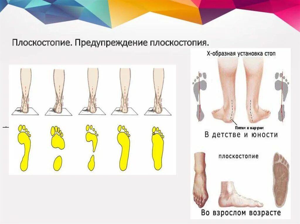 плоскостопие у детей. плантография стопы у детей. плоскостопие в 1 год. плоскостопие по степеням. плоскостопие в 1 год.