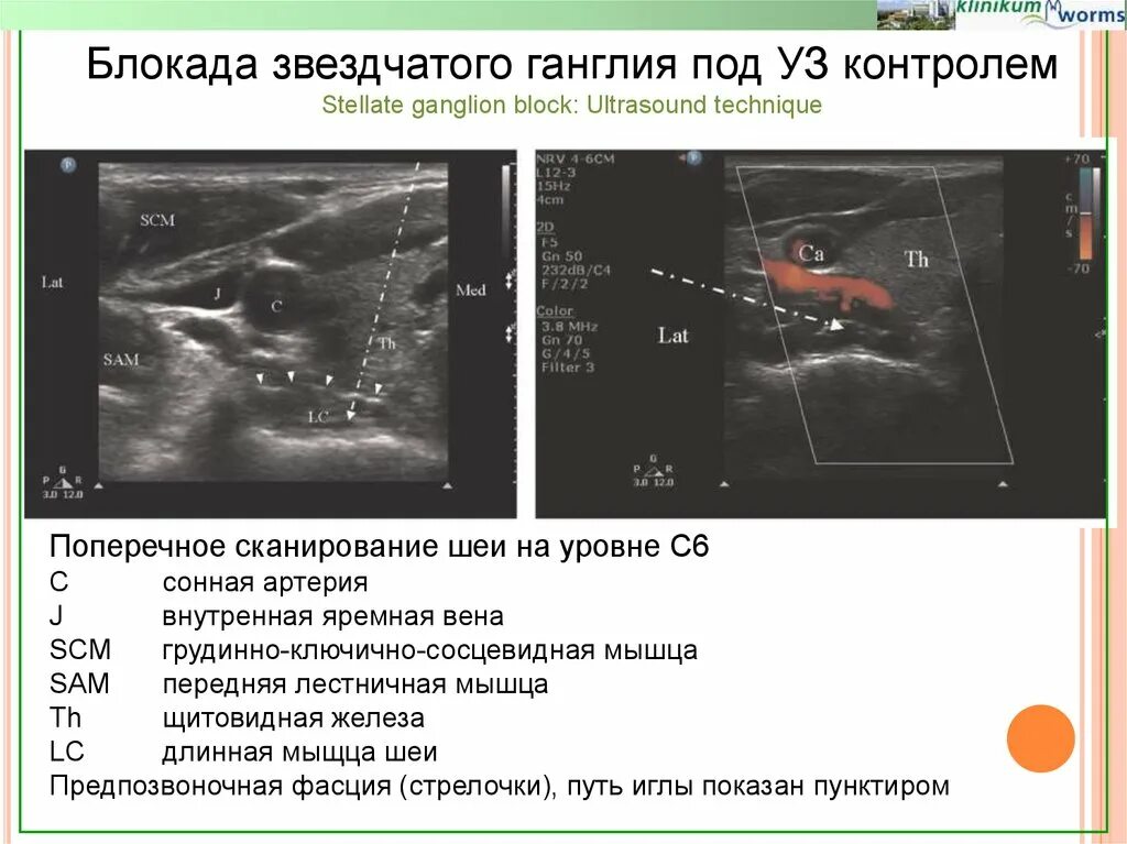 Блокада узла. Блокада звездчатого ганглия. УЗИ звездчатого ганглия. Это блокада нерва под УЗИ контролем. Поперечное сканирование.