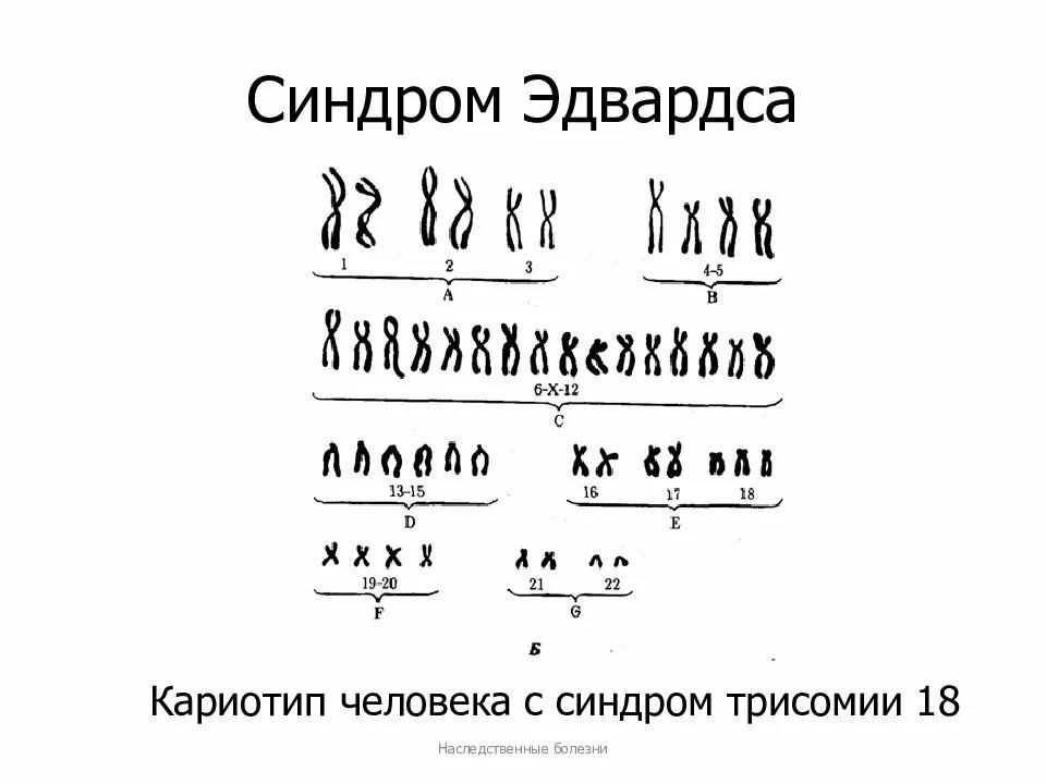 Синдром дауна генотип и фенотип. Кариотип больного с синдромом эдвардса. эдвардс синдром кариотип. формула кариотипа при синдроме эдвардса. кариотип при синдроме эдвардса.