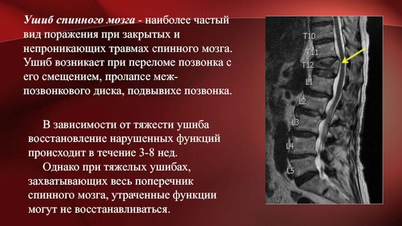 Отдел разрыв. Повреждение спинного мозга в поясничном отделе. Повреждение поясничного отдела позвоночника симптомы. Компрессионный перелом тела 12 грудного позвонка спинного мозга. Разрыв спинного мозга шейного отдела.