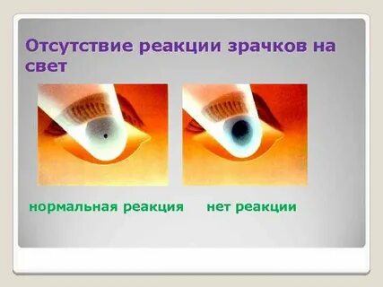 Зрачковые реакции
