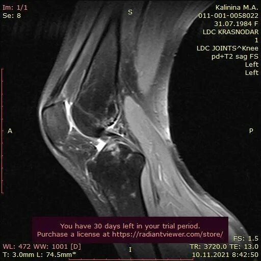 Контузия коленного сустава на мрт. Микроперелом колена снимок. Застарелые травмы колена мрт. Остеопения коленного сустава мрт.