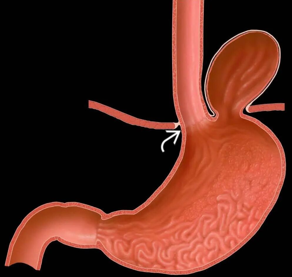 Грыжа пищеводного отверстия диафрагмы. Грыжа пищеводного отверстия желудка. Диафрагмальная грыжа пищевода. Хиатальная грыжа пищеводного отверстия. Пищевод картинка