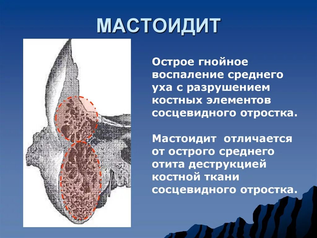 Утолщение слизистой сосцевидного отростка. Признаком острого мастоидита является. Мастоидит клиническая картина. Воспаление сосцевидного отростка. Мастоидит сосцевидного отростка.