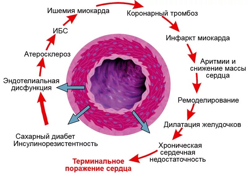 Сосудистые осложнения при сахарном диабете 1 типа. Патогенез дисфункции эндотелия. Эндотелиальная дисфункция при сахарном диабете. Эндотелиальная дисфункция и ХСН.