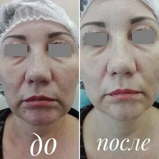 Мезотерапия иркутск