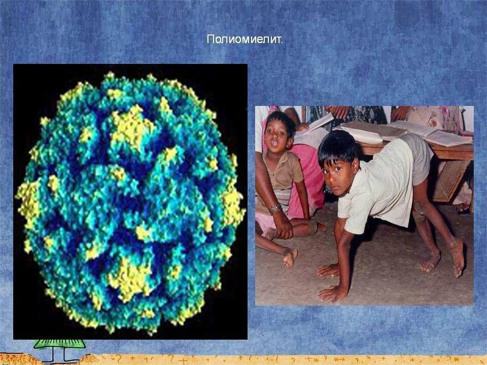 Полиомиелит это простыми словами. Непаралитический полиомиелит. Вирус полиомиелита профилактика. Вирус полиомиелита больные.