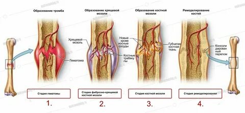 Как долго болят кости после перелома
