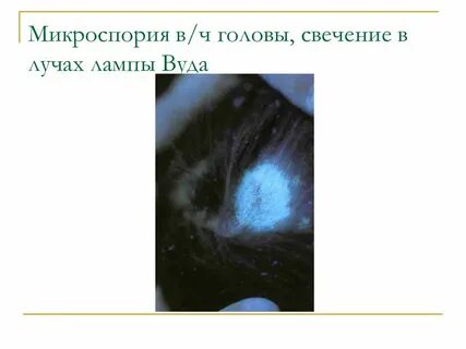 Лучи лампы вуда