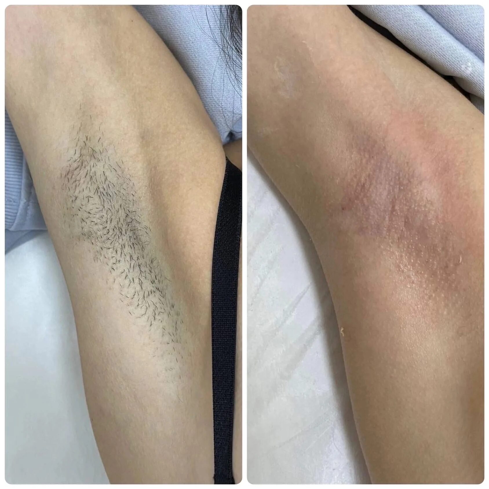 Красивая депиляция. Эпиляция и депиляция. Депиляция шугаринг. Восковая депиляция. Эпиляция в феврале 2024.