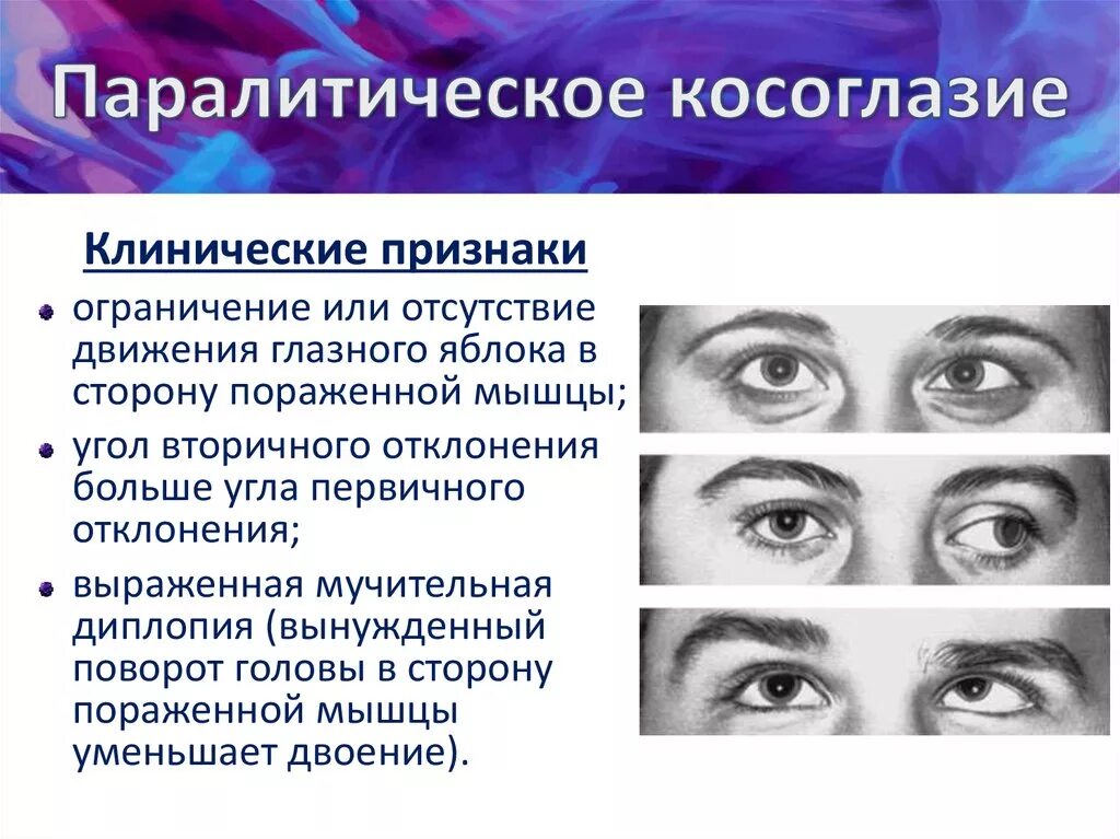 Можно ли вылечить косоглазие. Содружественное альтернирующее косоглазие. паралитическое косоглазие. паралитическое косоглазие у детей. паралитисеское комогоазие.