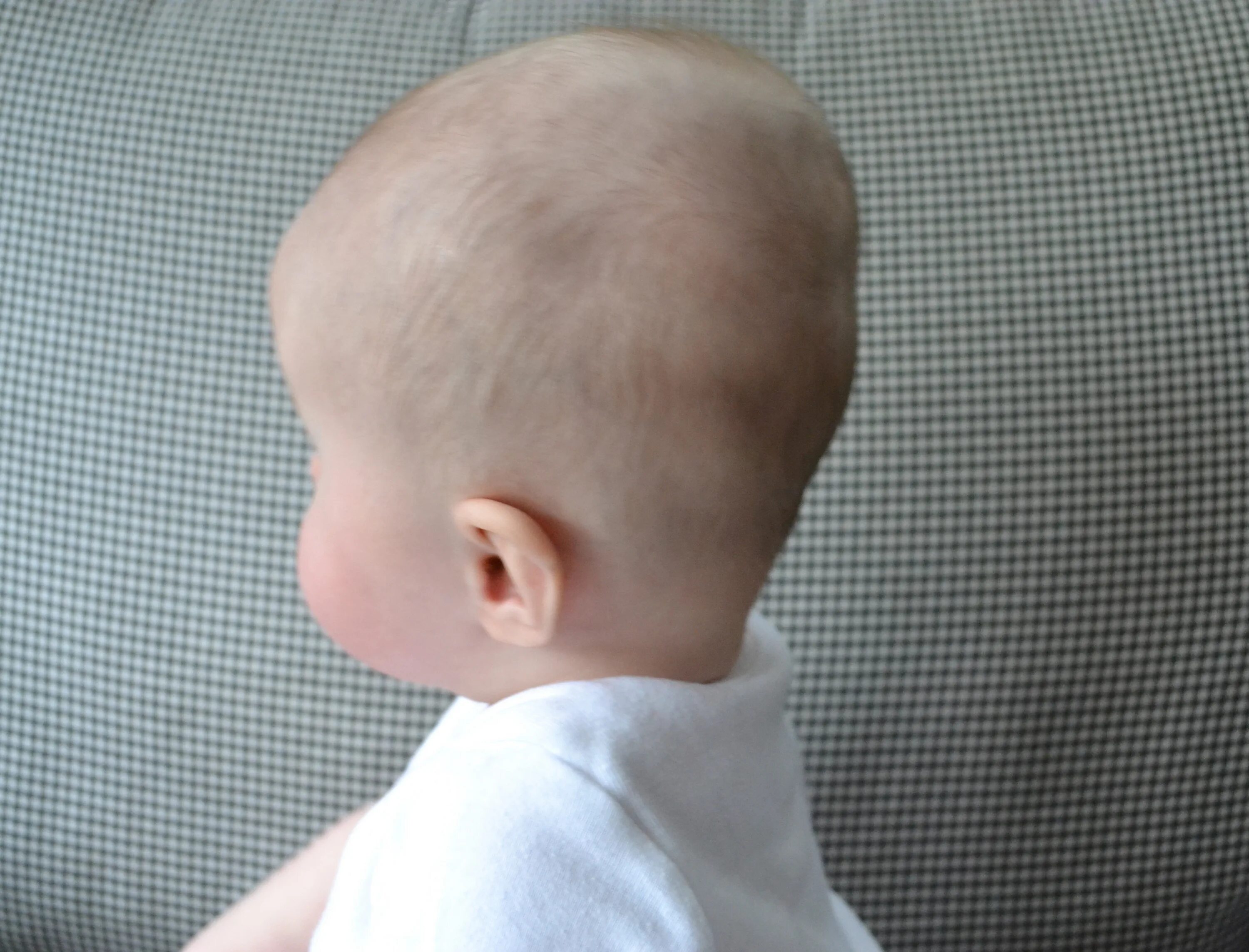 Родничок фото. Лобная кефалогематома. Краниостеноз брахицефалия. Форма головы новорожденного.