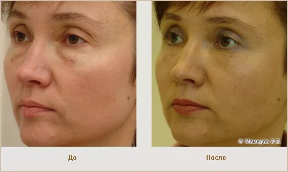 Липофилинг лица отзывы до и после Face Lift Омолаживающая подтяжка лица и шеи методом High SMAS, эндоскопическая п