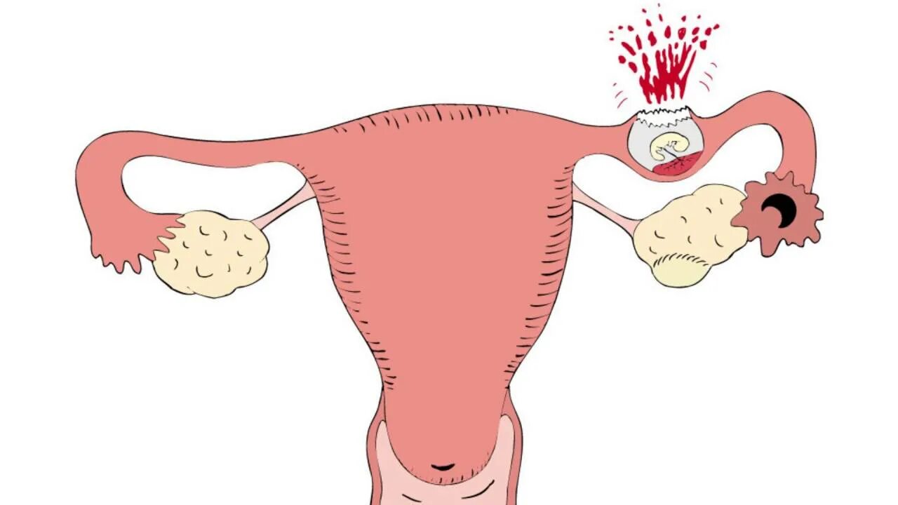 Маточные трубы удаление месячные. Внематочная беременность разрыв маточной трубы. Внематочная беременность трубный разрыв. Внематочная (эктопическая) беременность. Патоморфология внематочной беременности.