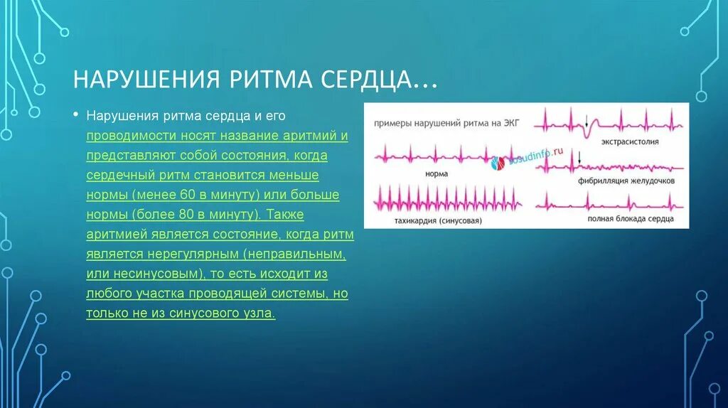 Аритмия и гипертония. Синусовая Мерцательная аритмия ЭКГ. Нарушение ритма. Ритм синусовая аритмия. Нарушения ритма на ЭКГ.