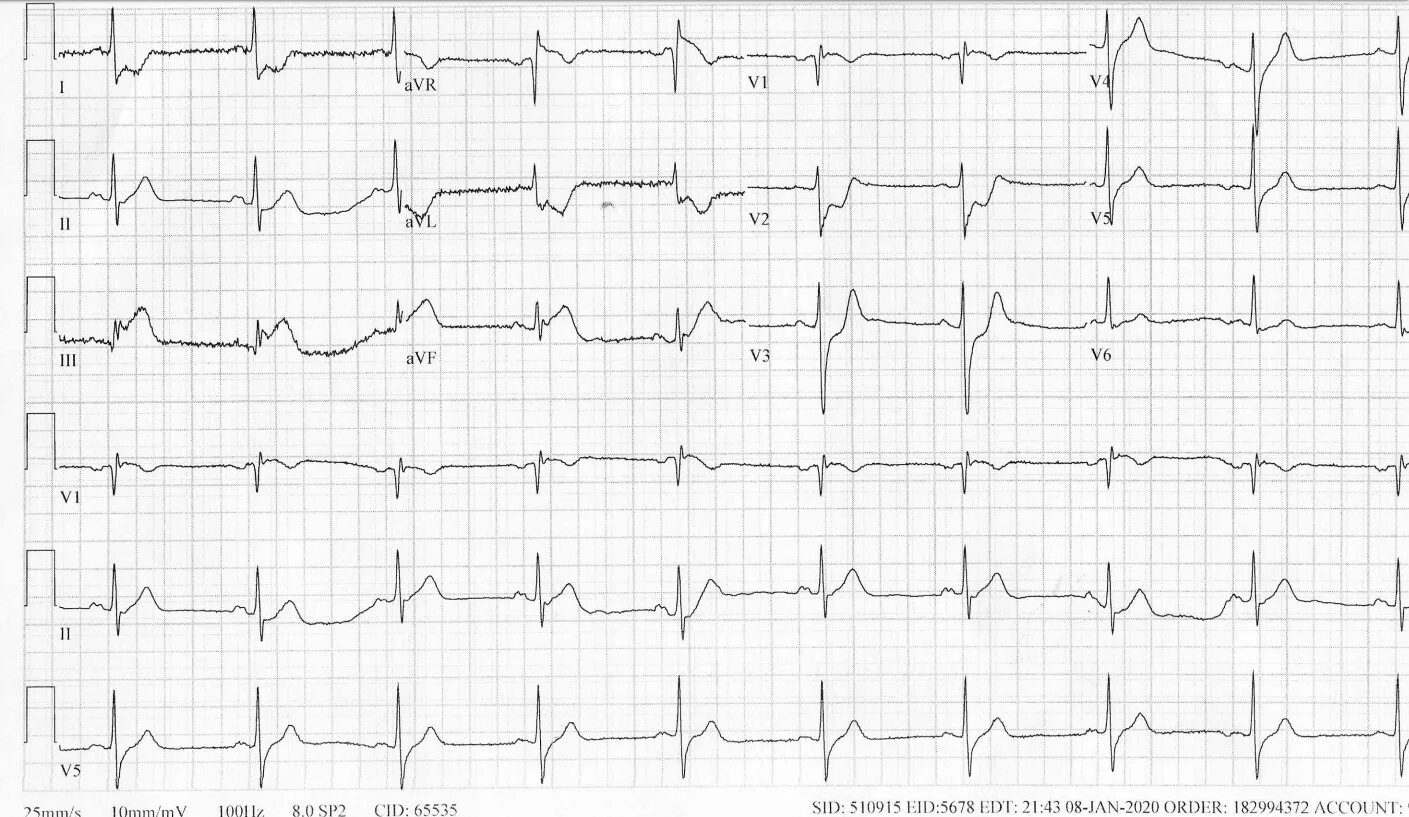 Мв на экг. Дигиталисная интоксикация на ЭКГ. Myocardial infarction ECG. ЭКГ ECG-1112. Торсада де ПОИНТС ЭКГ.