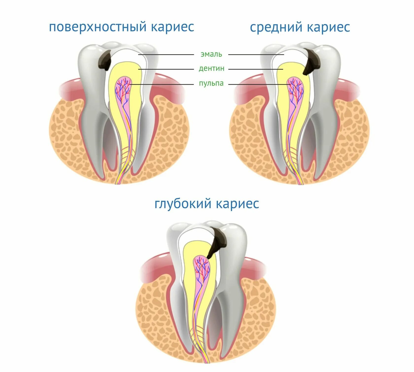Сколько ходят с лекарством в зубе. Кариес эмали (поверхностный кариес) патанатомия. Поверхностный средний и глубокий кариес.