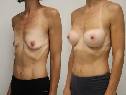 Before & After Breast Augmentation Case 42 View #1 View in Gilbert, AZ.