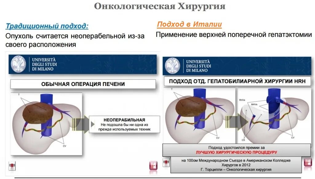 Терапия рака печени. Радиочастотная абляция метастазов печени. Трансплантация печени. Раковые поражения печени. Резекция печени с опухолью.