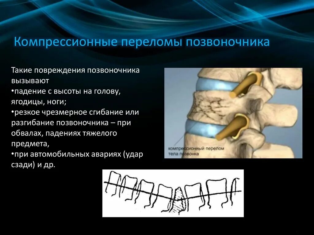 Ребенок сломал позвоночник. Компрессионный перелом позвоночника l12. Компрессионный перелом позвоночника th12 l3. Компрессионный перелом позвоночника l1 операции. Компрессионный перелом тела л2 позвонка.