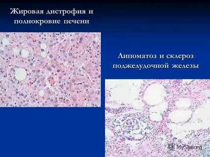Что такое липоматоз поджелудочной железы 1 степени