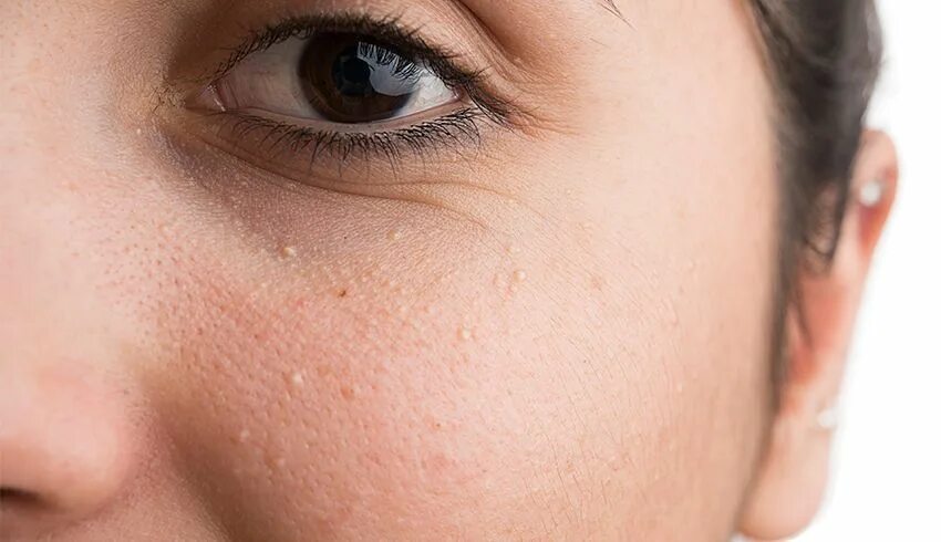 Say Goodbye to Milia: How to Get Rid of Those Tiny Bumps on Your Skin