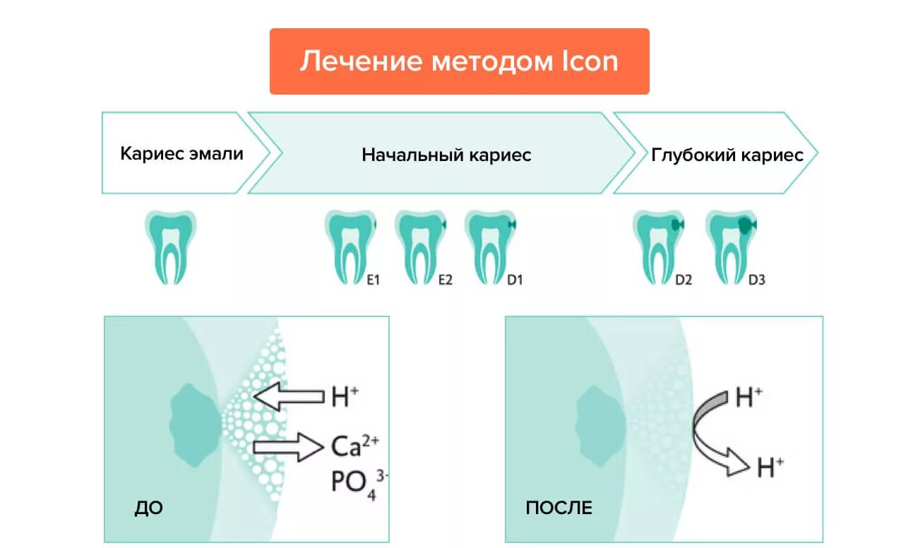 Метод icon. Метод инфильтрации эмали в стоматологии. Лечение кариеса инфильтрационным методом icon. Лечение кариеса эмали методом инфильтрации (icon). Icon стоматология методика.