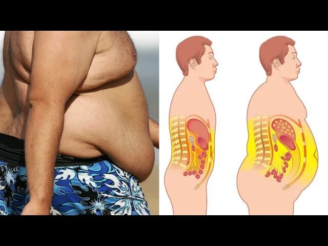 Толстый под жиром. Подкожный и висцеральный жир. Ожирение висцеральный жир. Висцеральный жир у мужчин.