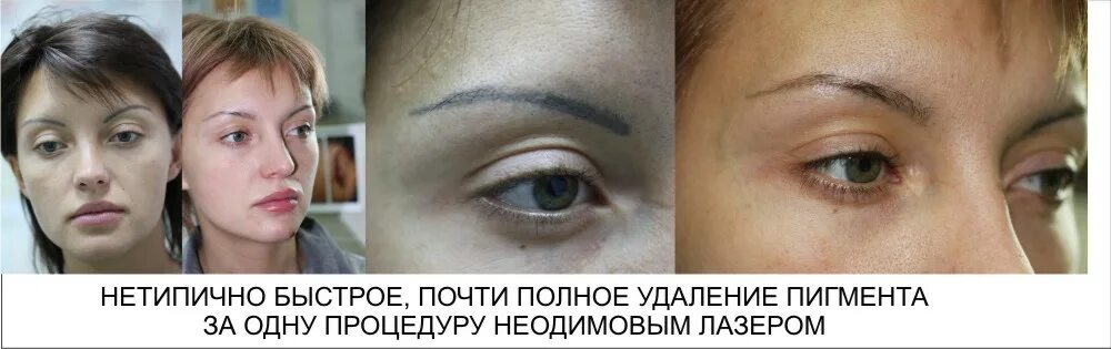 Удаление стрелок лазером до и после отзывы Удаление татуировок в Красноярске Красота: 39 мастеров по удалению тату со сре