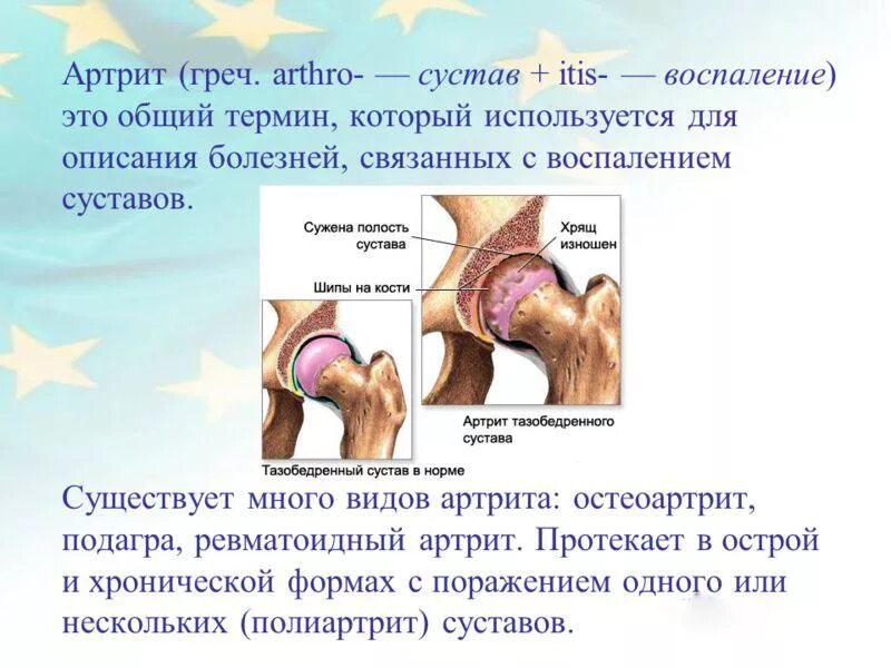 Артрит это. Заболевания суставов презентация. Врожденные заболевания суставов. Ревматоидный полиартрит презентация.