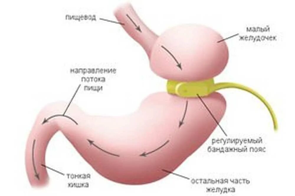 После удаления части желудка. Кольцо на желудок для похудения. Лапароскопическое бандажирование желудка. Операция по уменьшению желудка. Операция кольцо на желудок для похудения.