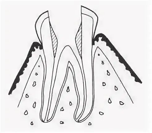 Обработка корневых каналов техники