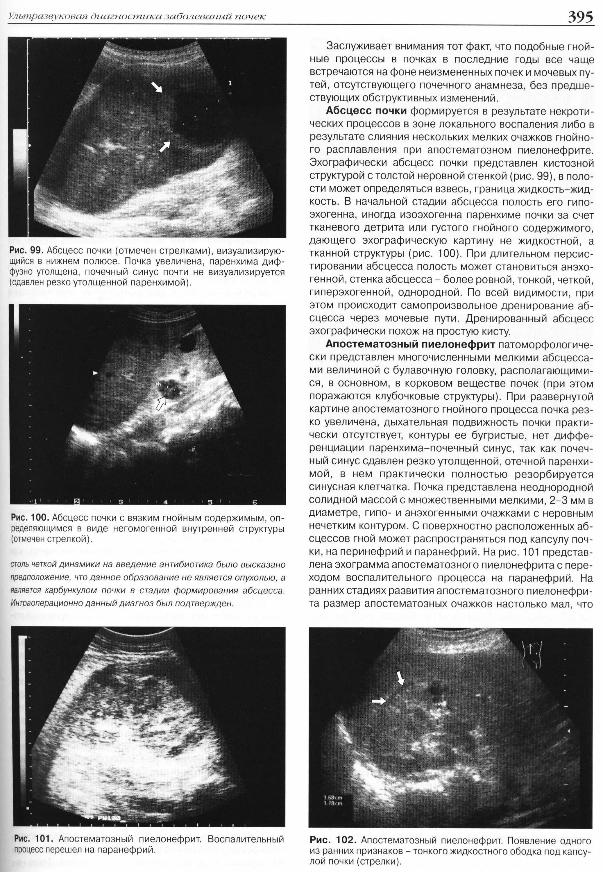Узи почек диагнозы. Пиелонефрит УЗИ картина. Острый пиелонефрит УЗИ картина. УЗИ картина апостематозного пиелонефрита. Апостематозный пиелонефрит по УЗИ.