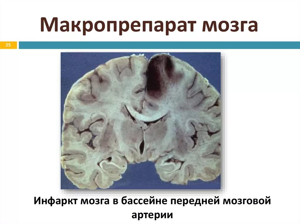 Инфаркт мозга причины. Инфаркт головного мозга макропрепарат. Ишемический инфаркт мозга патанатомия. Ишемический инфаркт головного мозга макропрепарат описание. Цереброваскулярные заболевания макропрепарат.