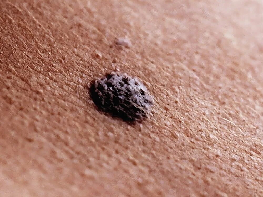 Шершавые коричневые. Шершавые коричневые. Лентиго, хлоазма, веснушки. Шершавые коричневые. Коричневое шершавое пятно.