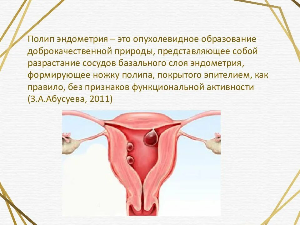 Полип эндометрия матки без операции. Эндометриальный полип. полип эндометрия патогенез. образование эндометрия в матке.