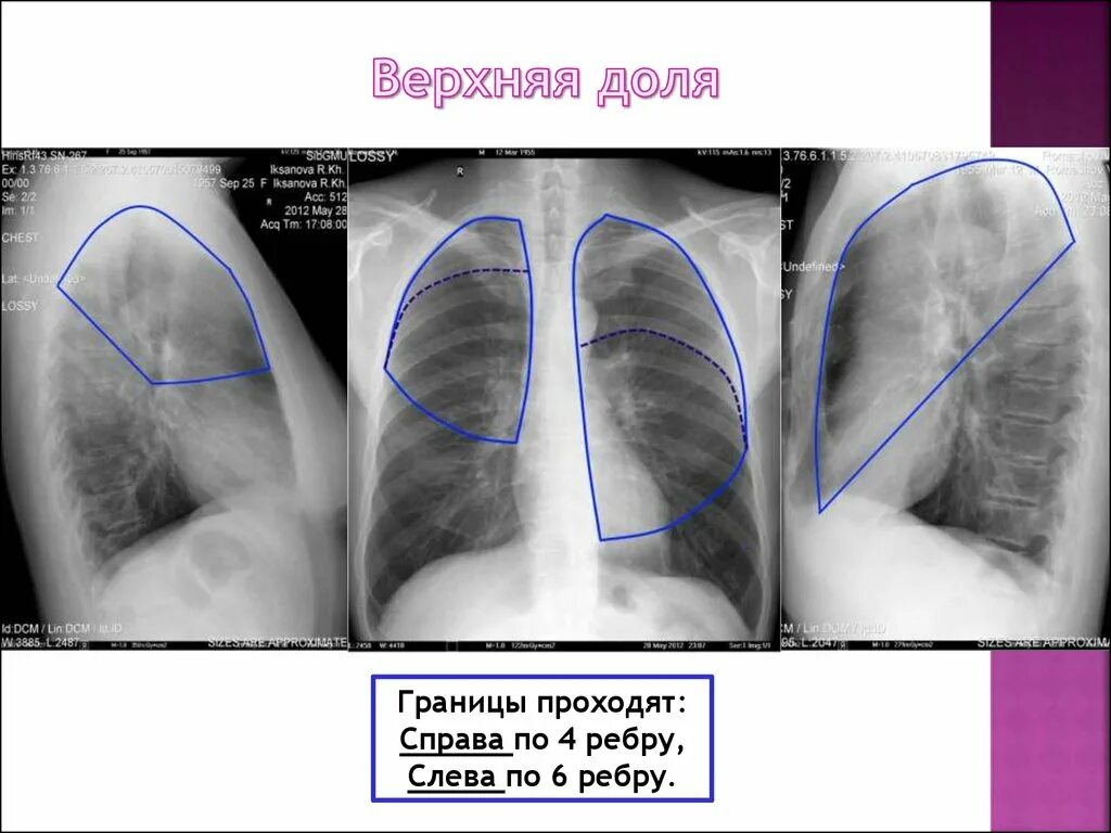 Доли легкого на рентгенограмме. Рентгеноанатомия органов грудной клетки в прямой и боковой проекции. Рентгенанатомты легких грудной клетки. Доли легких рентген. Анатомия легких рентген.