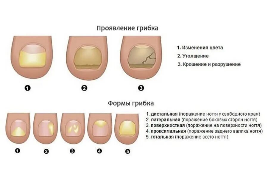 Как выглядит ноготь пораженный грибком. Как выглядит начальный грибок на ногтях на ногах. Грибок ногтей начальная стадия. Как выглядит начинающий грибок на ногтях. Изменение формы ногтей