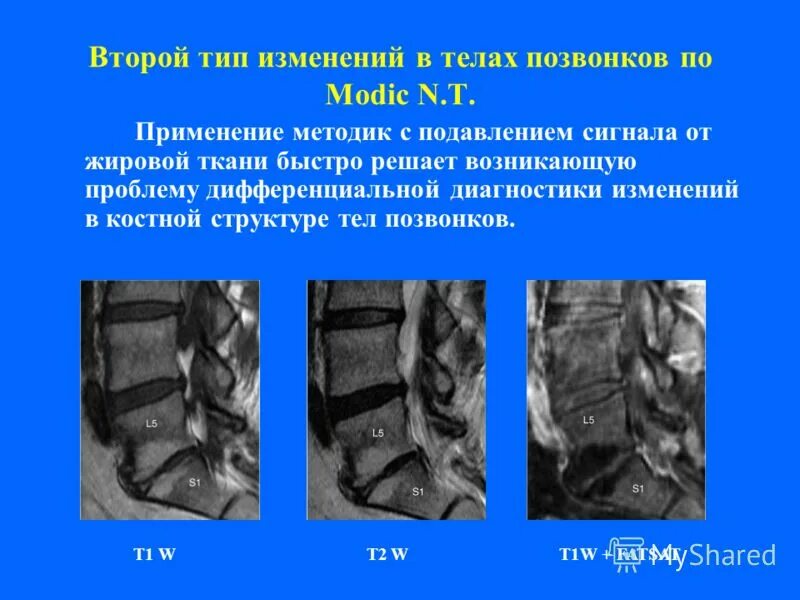 Дегенеративные изменения по типу modic 1-2. Спондилодисцит модик. Modic 1. Жировая дегенерация modic тип2. Modic тип 1.