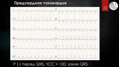 Тахикардия qrs