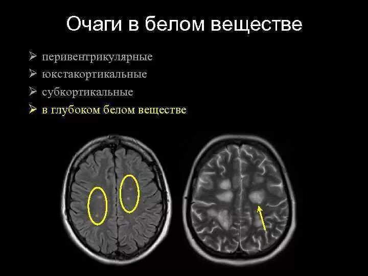 Мр картина очагов. Очаговые изменения вещества головного мозга дисциркуляторного. Единичные очаги в субкортикальном белом веществе головного мозга. Единичные очаги глиоза в белом веществе головного мозга. Субкортикальные очаги в белом веществе головного мозга мрт.