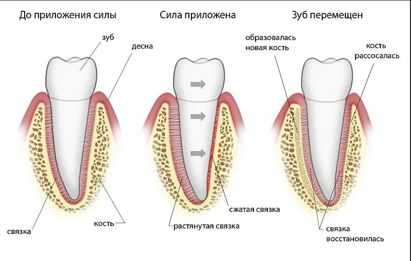 Брекеты схема установки. Зуб.