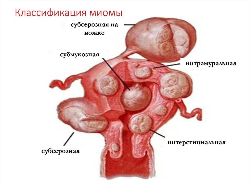 Миома матки болит живот. Субмукозная миома классификация. Субмукозная миома матки классификация. Интерстициальная миома матки симптомы. Интерстициальная миома матки малых размеров что это.