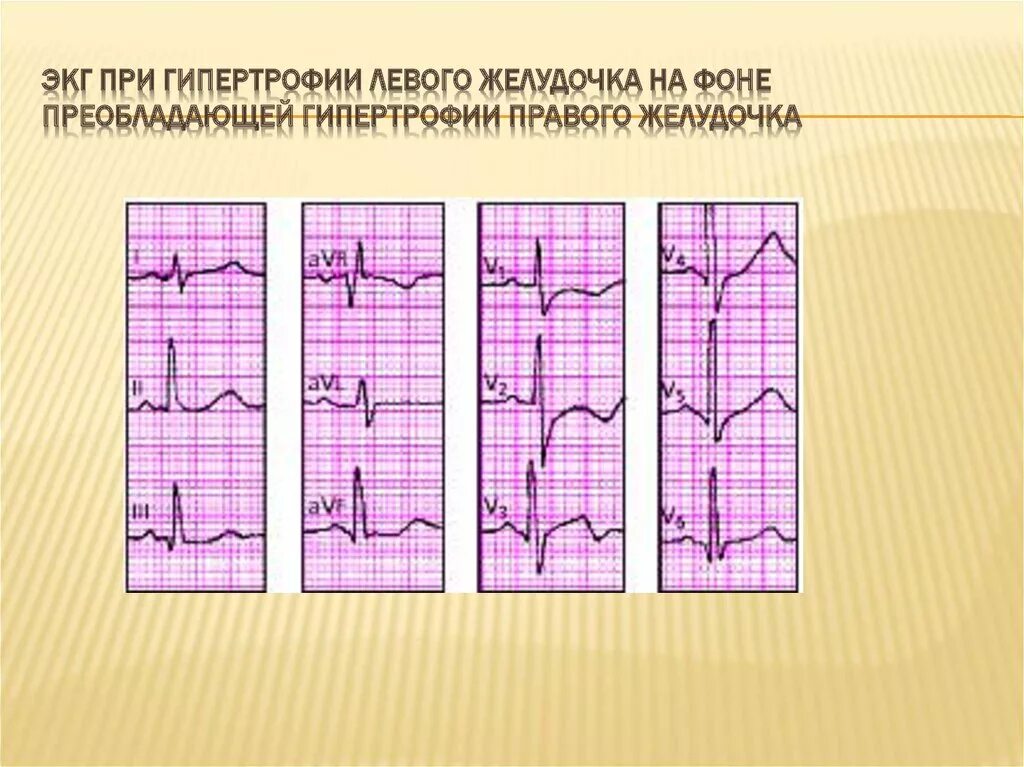 Гипертрофия обоих желудочков на ЭКГ. Гипертрофия левого желудочка ЭКГ рисунок. Гипертрофия левого и правого желудочка на ЭКГ. ЭКГ при гипертрофии левого желудочка. Гипертрофия левого предсердия левого желудочка