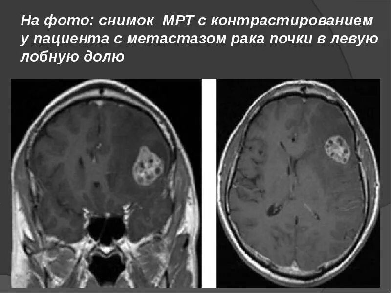 Лечение метастазов мозга. Метастатические опухоли головного мозга. Метастазы головного мозга кт. Опухоль головного мозга метастазы.