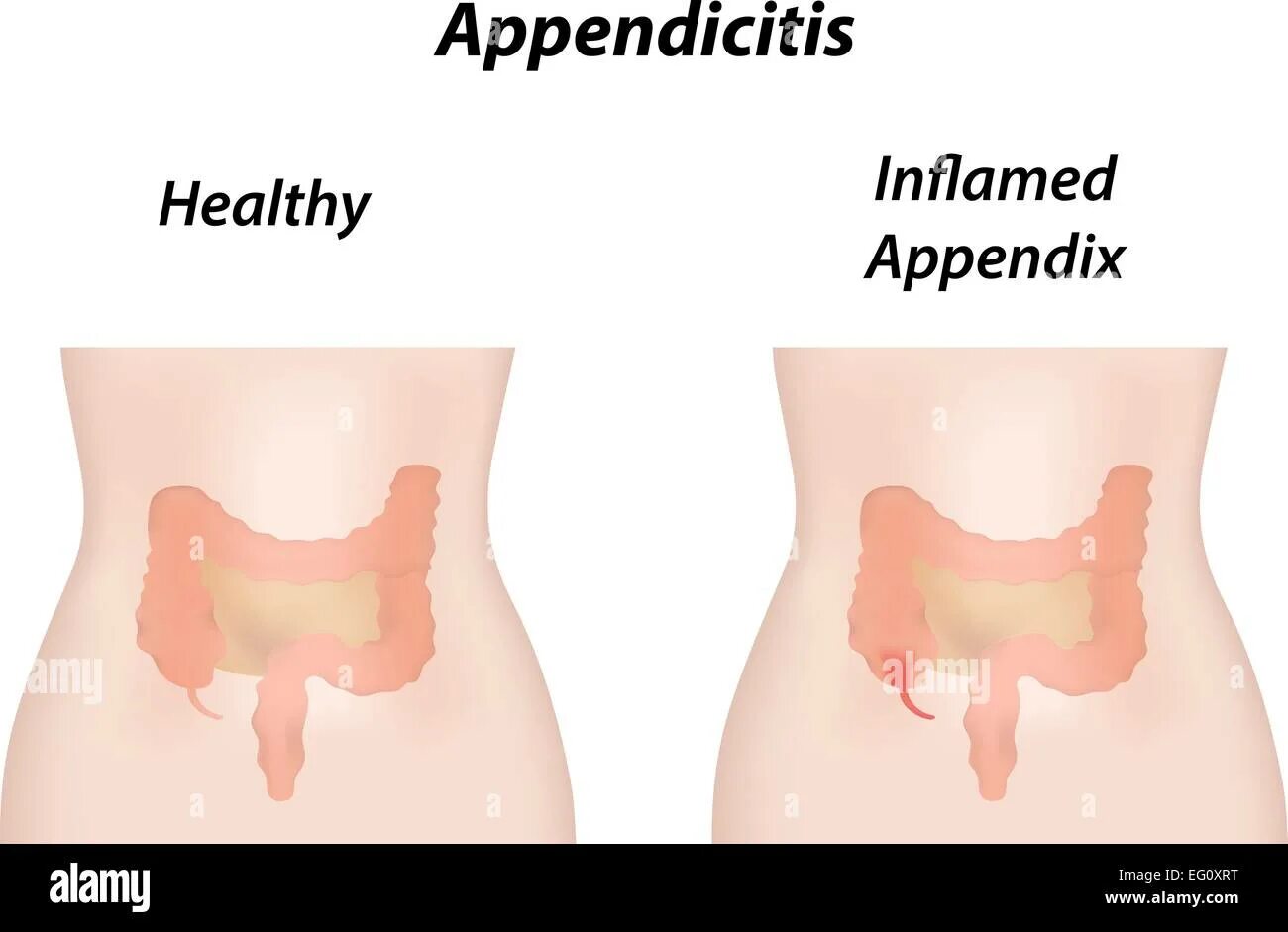 С какой стороны живота находится аппендицит. Аппендицит расположение у женщин. Как выглядит аппендикс.
