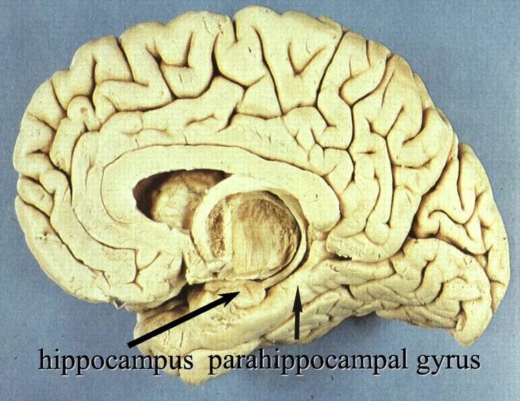 Повреждение гиппокампа. Parahippocampal gyrus. Анатомия гиппокампа. Аммонов Рог головного мозга. Гиппокамп анатомия препарат.